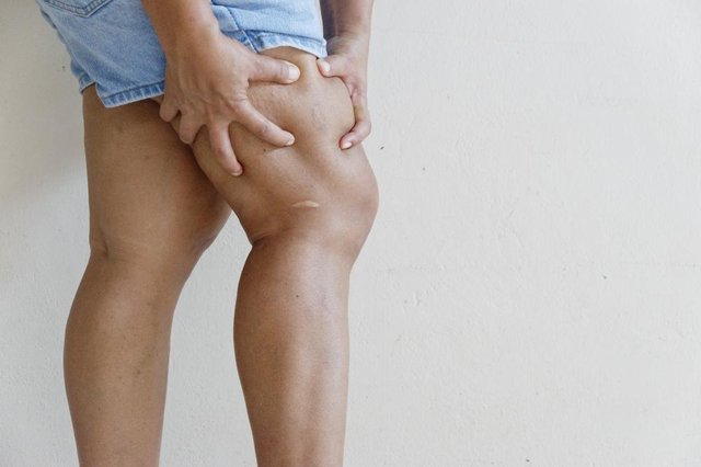 Deep Vein Thrombosis