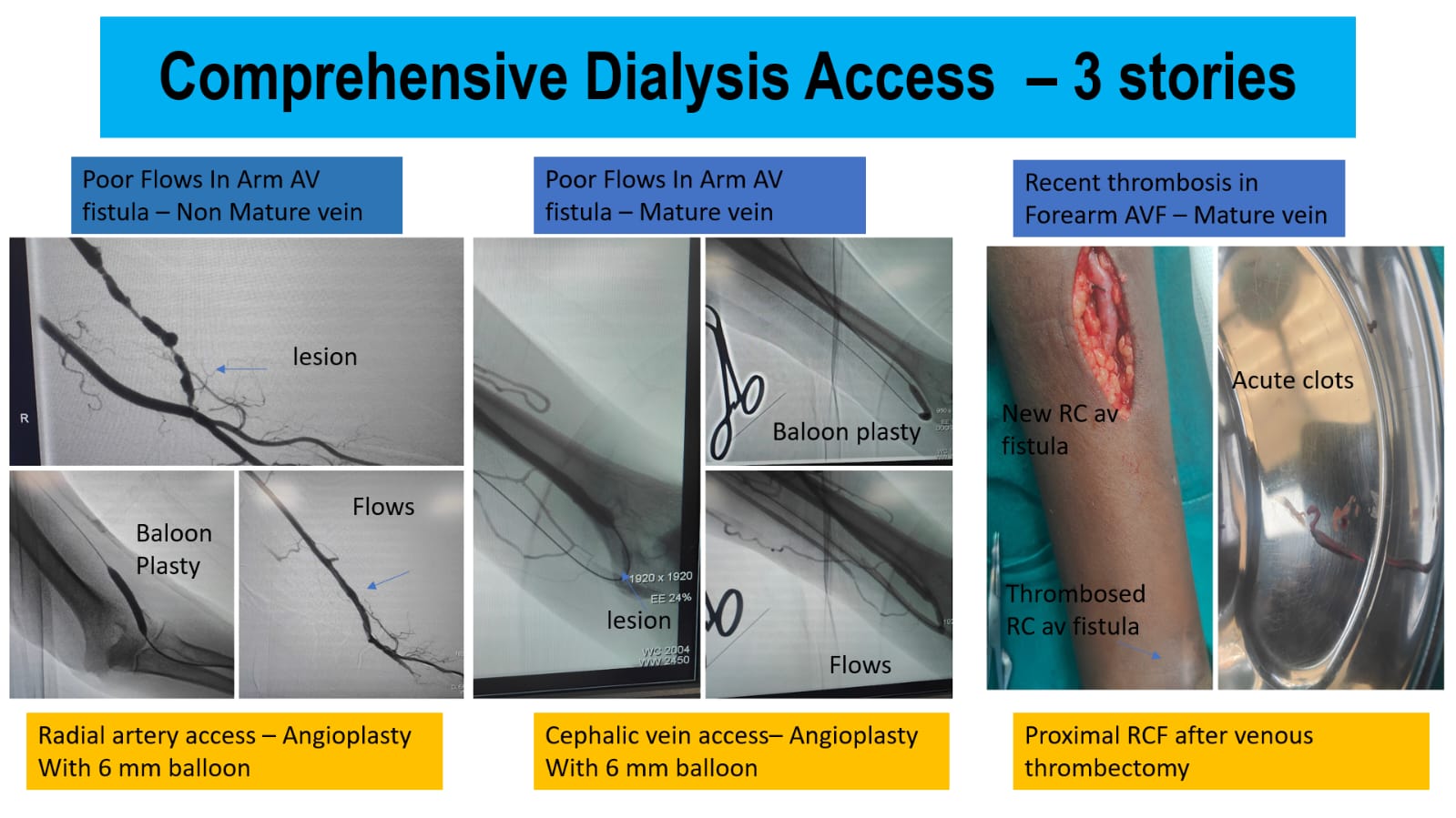 Modern DVT Treatment