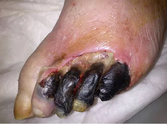 Gangrene