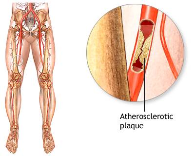Deep Vein Thrombosis