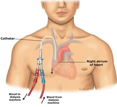 Deep Vein Thrombosis