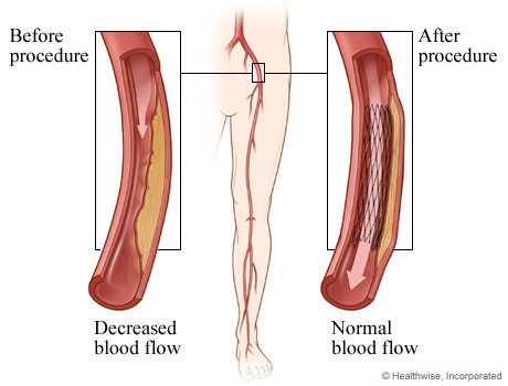 Deep Vein Thrombosis