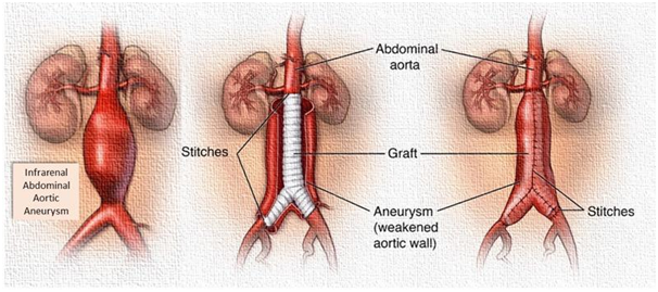Aortic aneurysm