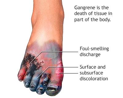 Causes of Gangrene