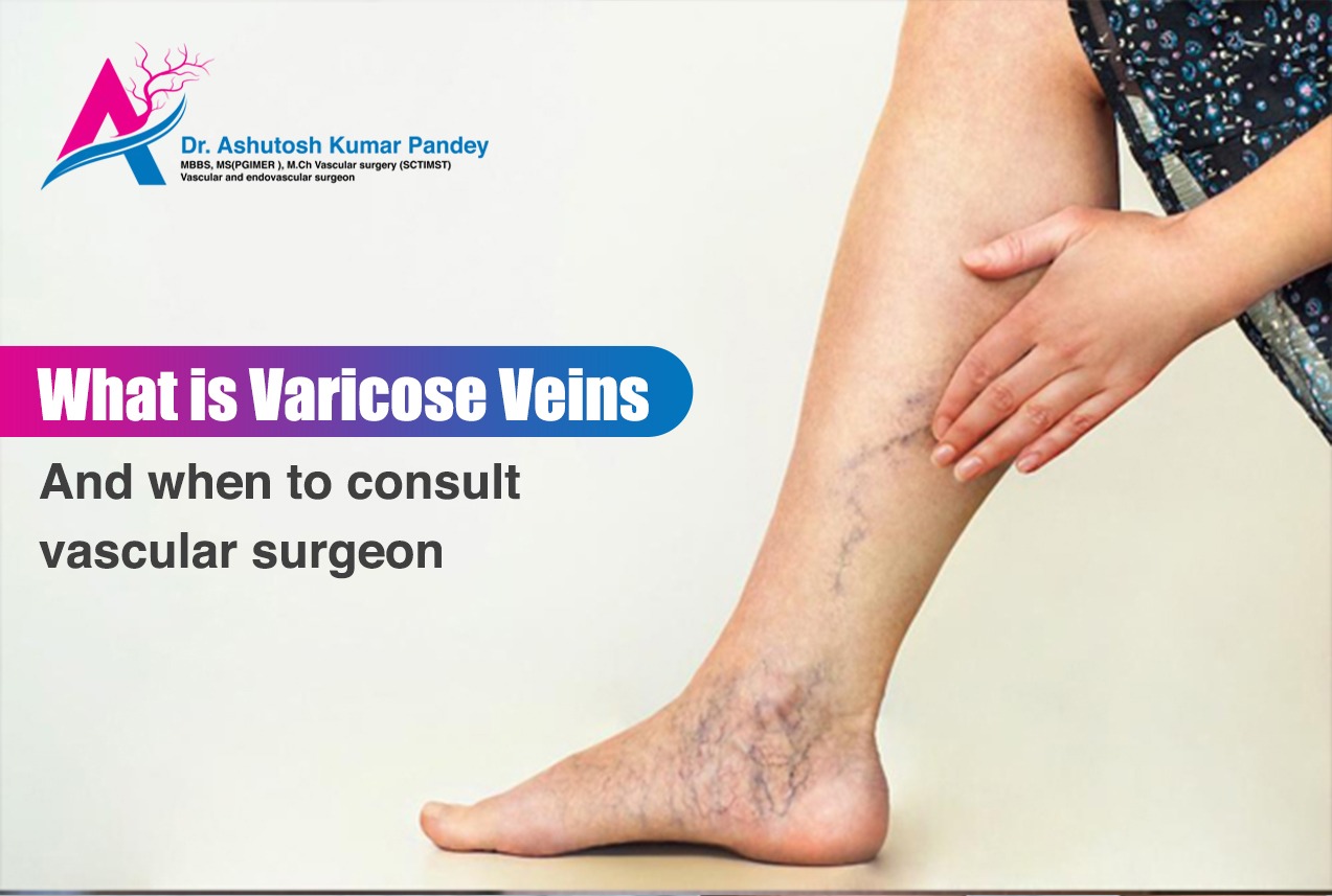What is varicose veins and when to consult vascular surgeon
