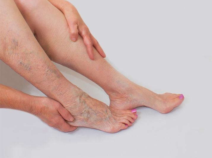 varicose veins treatment in lucknow