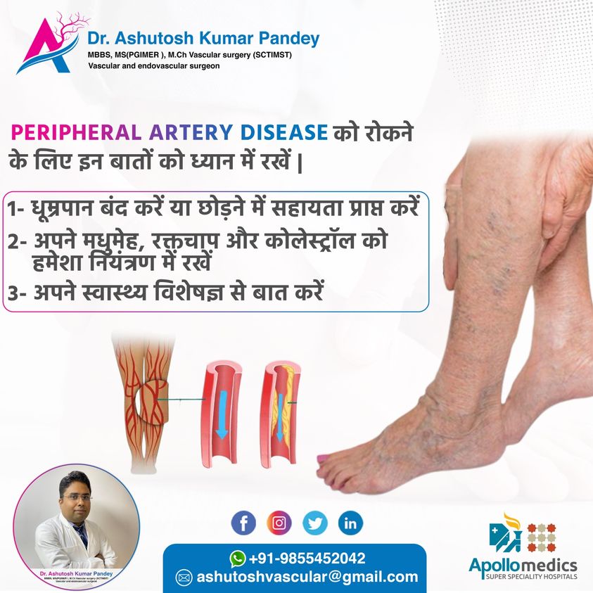 Peripheral Arterial Disease in Lucknow