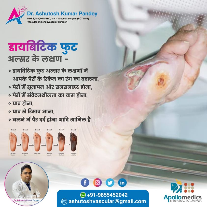 Diabetic foot doctor in Lucknow