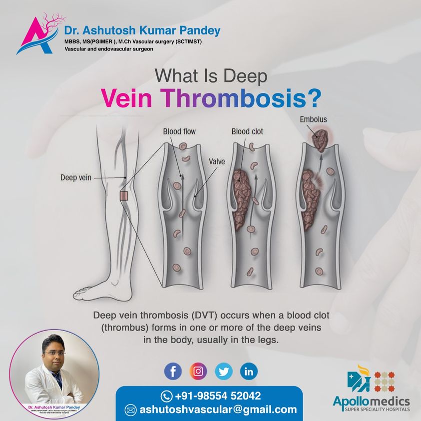 Deep Vein Thrombosis Treatment In Lucknow