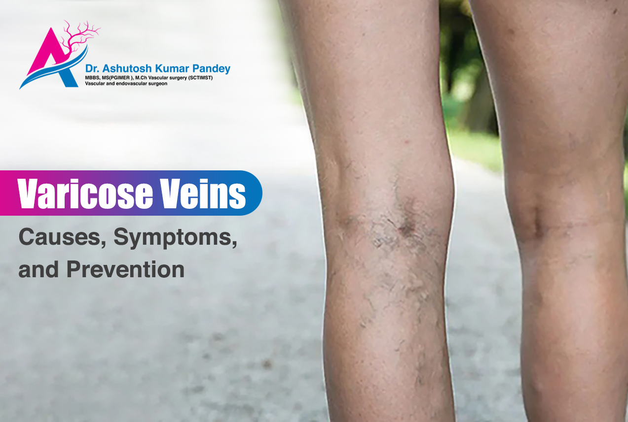 Varicose Veins: Causes, Symptoms, and Prevention